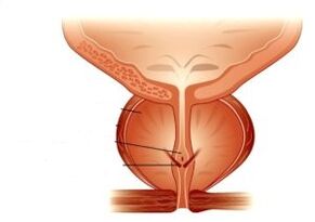 prostatitis and its treatment with drugs